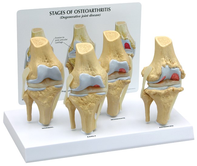 4-Stage Osteoarthritis Knee Model with Base