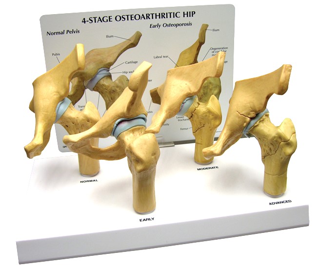 4-Stage Hip Model with Base